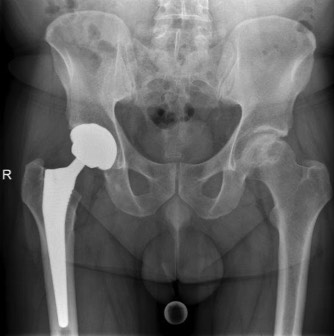 Heupprothese Dokter Dujardin Jan orthopedie heup en knie specialist traumatologie operatie nieuwe knie heup prothese meniscus kruisband sportgeneeskunde izegem hechting kraakbeen operatie chirurg heelkunde arthrose arthritis pijn petré defoort vandendriessche knieprothese heupprothese topdokter arts kunstknie topdokters beste kunstheup topchirurg