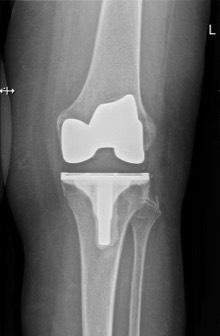 knieprothese Dokter Dujardin Jan orthopedie heup en knie specialist traumatologie operatie nieuwe knie heup prothese meniscus kruisband sportgeneeskunde izegem hechting kraakbeen operatie chirurg heelkunde arthrose arthritis pijn petré defoort vandendriessche knieprothese heupprothese topdokter arts kunstknie topdokters beste kunstheup topchirurg