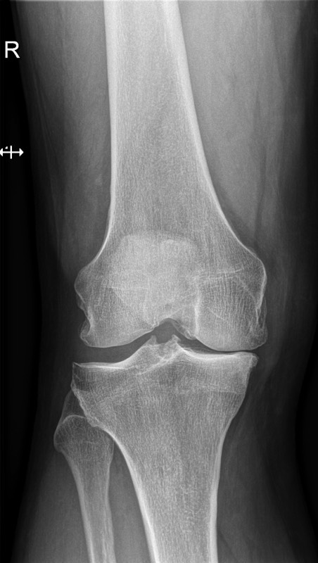 arthrose knie Dokter Dujardin Jan orthopedie heup en knie specialist traumatologie operatie nieuwe knie heup prothese meniscus kruisband sportgeneeskunde izegem hechting kraakbeen operatie chirurg heelkunde arthrose arthritis pijn petré defoort vandendriessche knieprothese heupprothese topdokter arts kunstknie topdokters beste kunstheup topchirurg