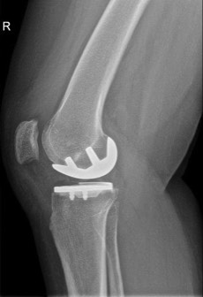 knieprothese Dokter Dujardin Jan orthopedie heup en knie specialist traumatologie operatie nieuwe knie heup prothese meniscus kruisband sportgeneeskunde izegem hechting kraakbeen operatie chirurg heelkunde arthrose arthritis pijn petré defoort vandendriessche knieprothese heupprothese topdokter arts kunstknie topdokters beste kunstheup topchirurg