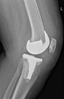 knieprothese Dokter Dujardin Jan orthopedie heup en knie specialist traumatologie operatie nieuwe knie heup prothese meniscus kruisband sportgeneeskunde izegem hechting kraakbeen operatie chirurg heelkunde arthrose arthritis pijn petré defoort vandendriessche knieprothese heupprothese topdokter arts kunstknie topdokters beste kunstheup topchirurg