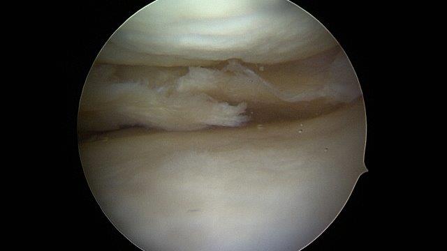 meniscusscheur Dokter Dujardin Jan orthopedie heup en knie specialist traumatologie operatie nieuwe knie heup prothese meniscus kruisband sportgeneeskunde izegem hechting kraakbeen operatie chirurg heelkunde arthrose arthritis pijn petré defoort vandendriessche knieprothese heupprothese topdokter arts kunstknie topdokters beste kunstheup topchirurg