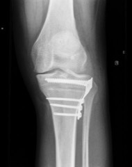 knie osteotomie Dokter Dujardin Jan orthopedie heup en knie specialist traumatologie operatie nieuwe knie heup prothese meniscus kruisband sportgeneeskunde izegem hechting kraakbeen operatie chirurg heelkunde arthrose arthritis pijn petré defoort vandendriessche knieprothese heupprothese topdokter arts kunstknie topdokters beste kunstheup topchirurg